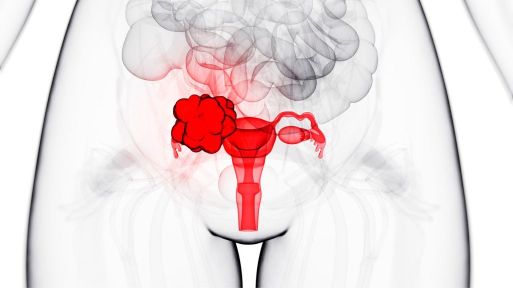 Rak jajnika przedstawiony na rysunku układu rozrodczego kobiety.